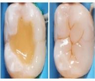 深圳牙科——粘結的基本原理是什麼呢?