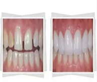 深圳箍牙——牙縫會有什麼影響呢？