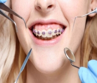 地包天可以矯正嗎？費用是多少呢?