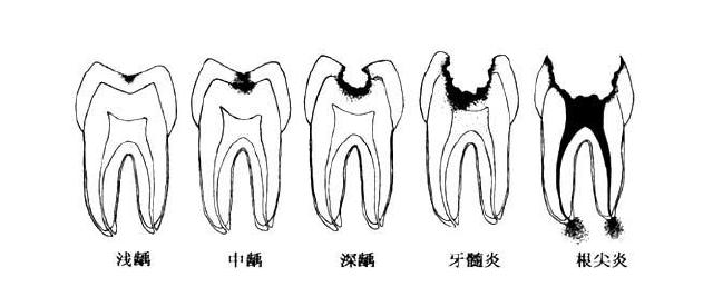 深圳蛀牙補牙