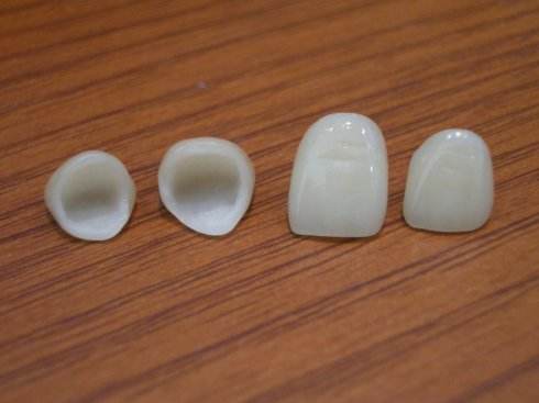 深圳瓷牙套