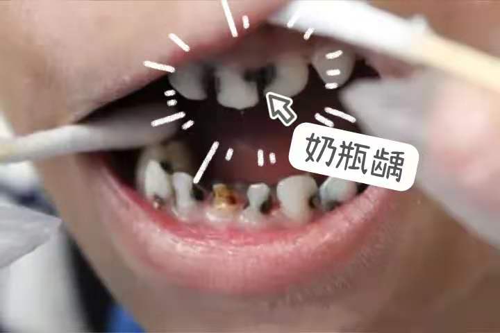 深圳兒童蛀牙
